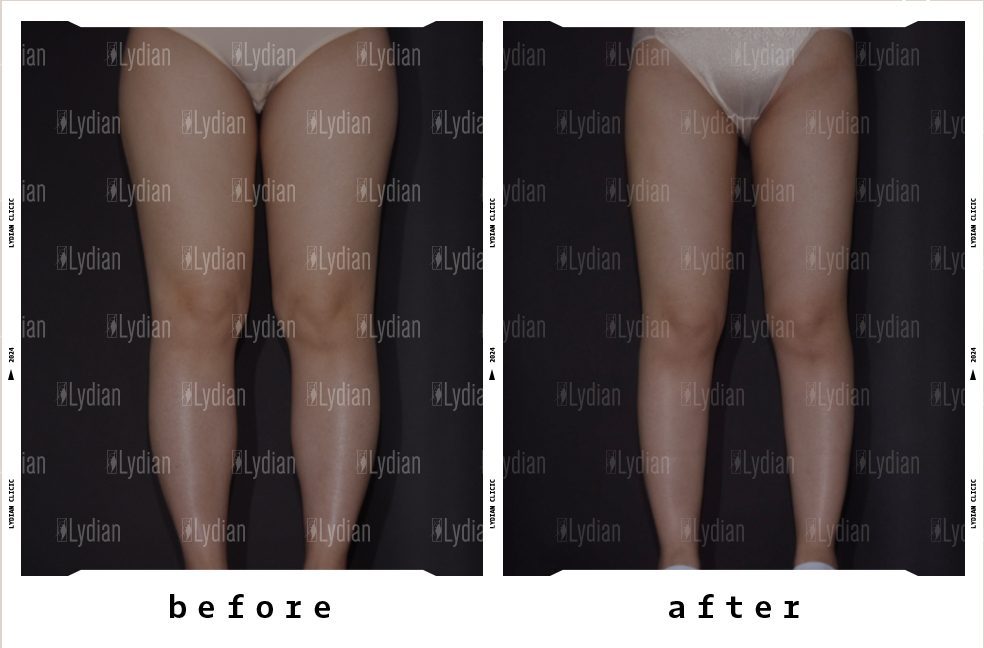 thigh gap before and after following liposuction