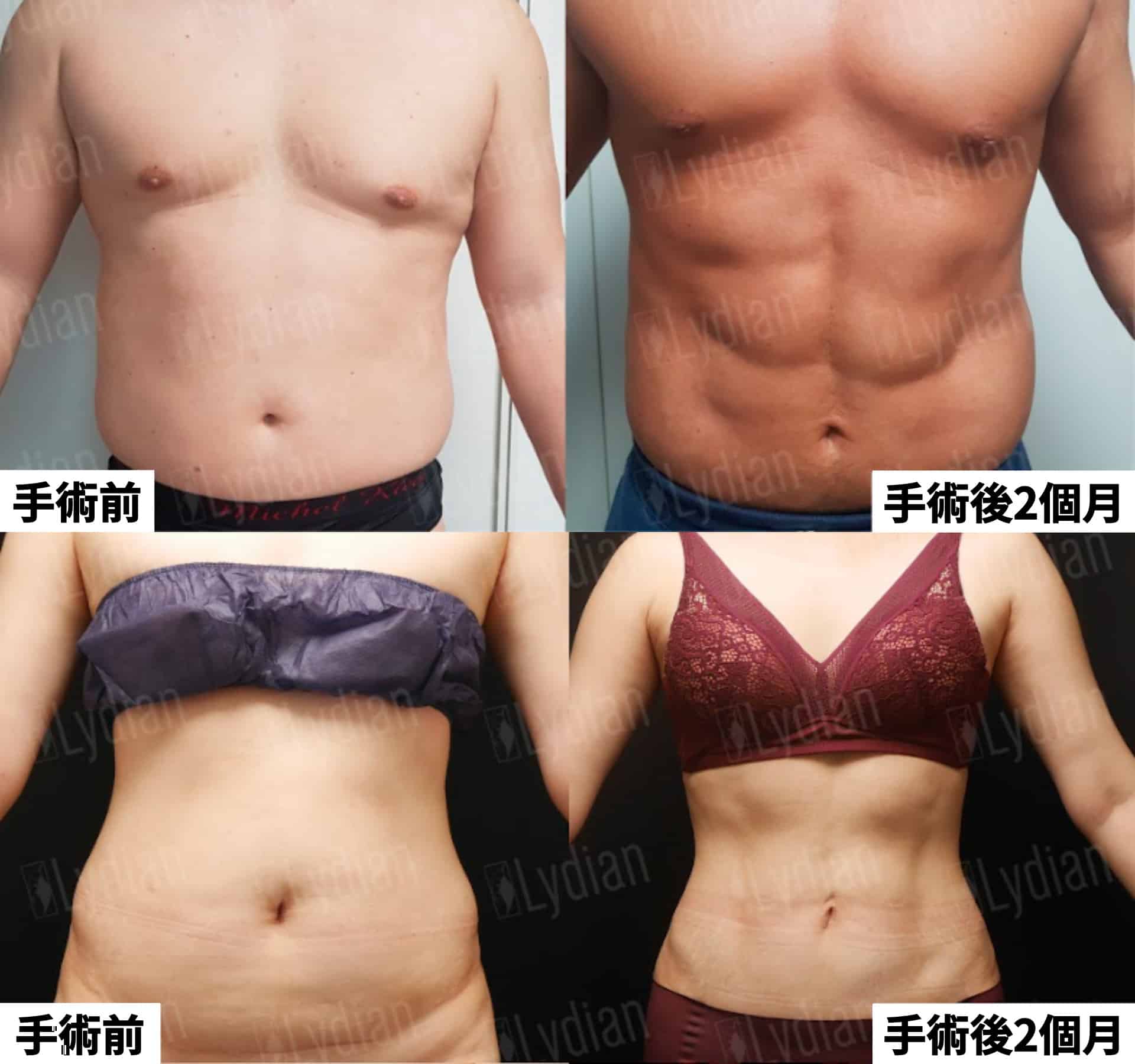 腹部抽脂術