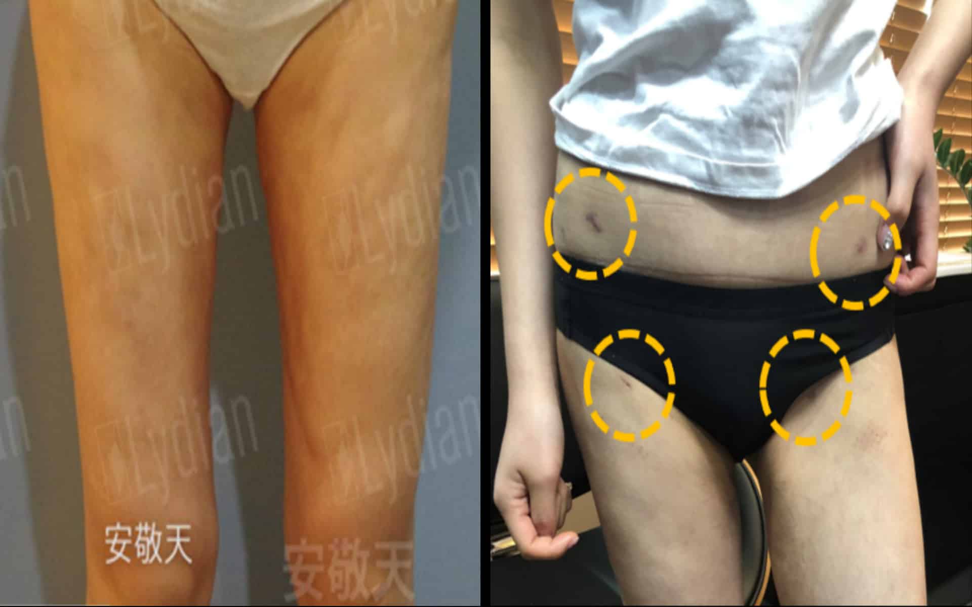 抽脂失敗