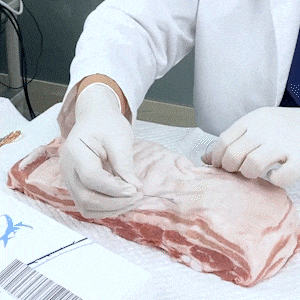 liposuction to chin