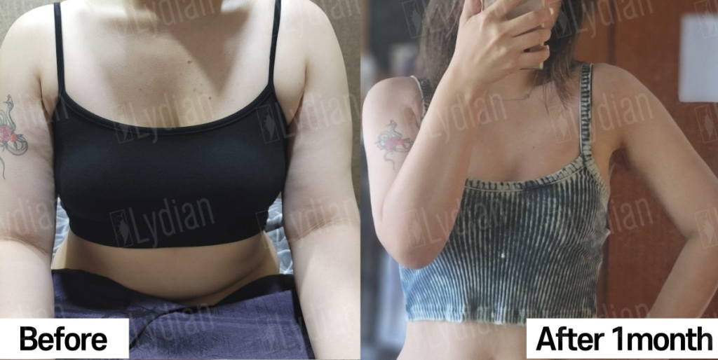 full body liposuction korea price