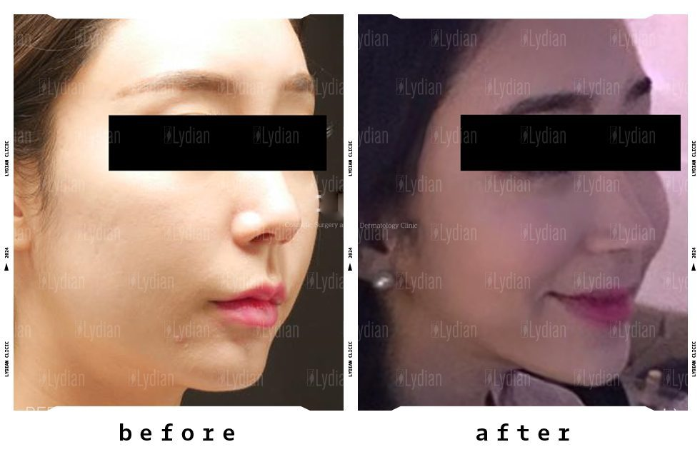 facial-liposuction-befor-and-after-photos