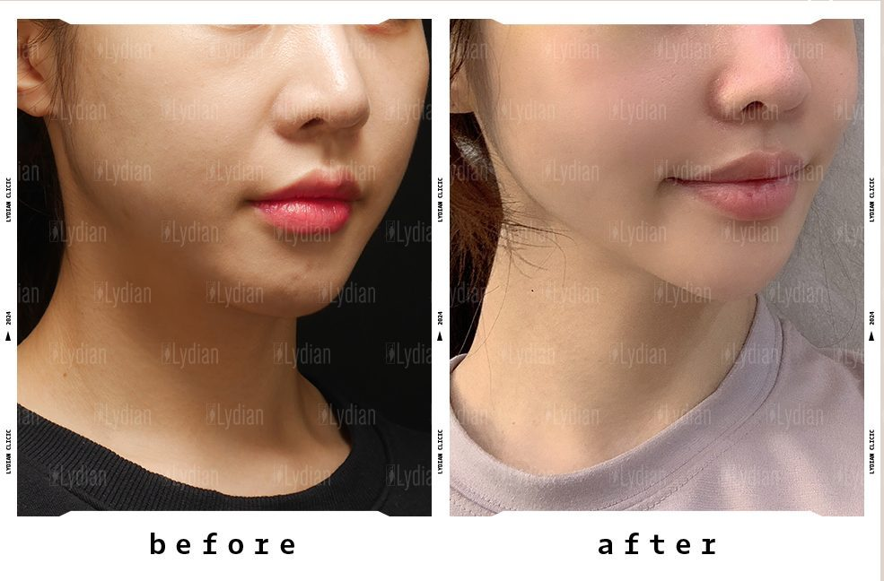 facial-liposuction-recovery
