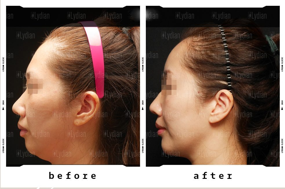 facial-liposuction-befor-and-after-photos-2