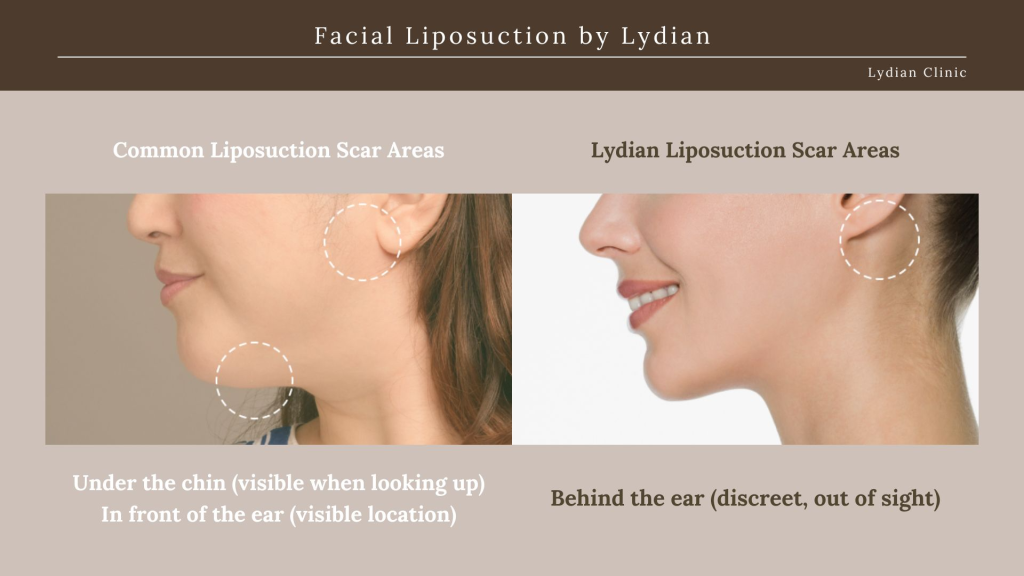 chin-liposuction-scars