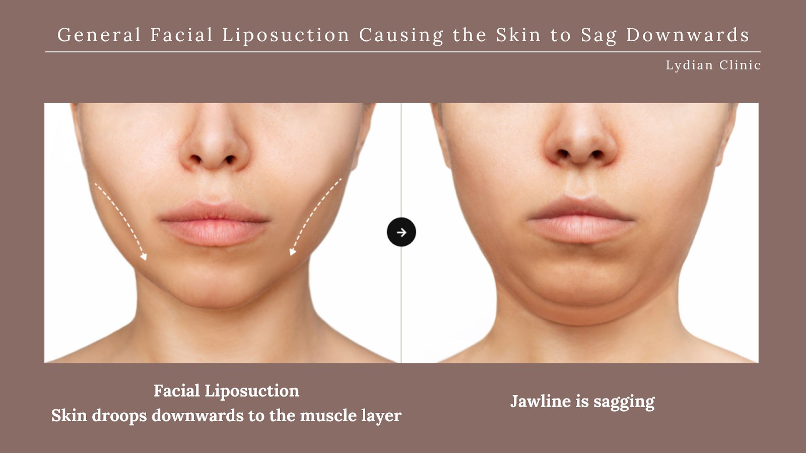 before and after chin lipo