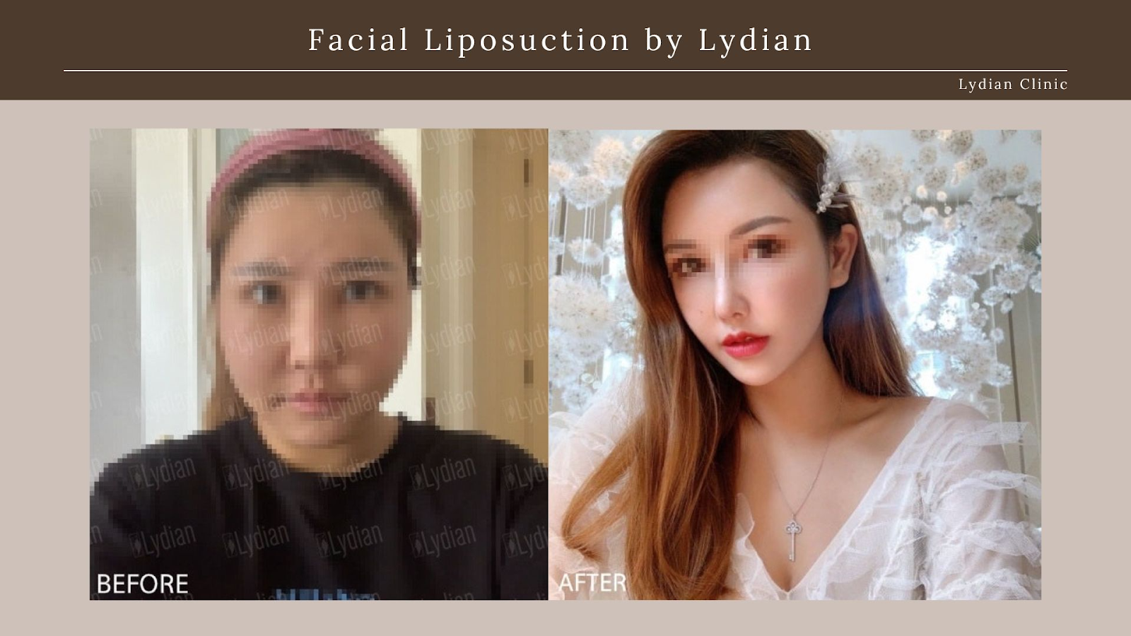chin-liposuction-korea