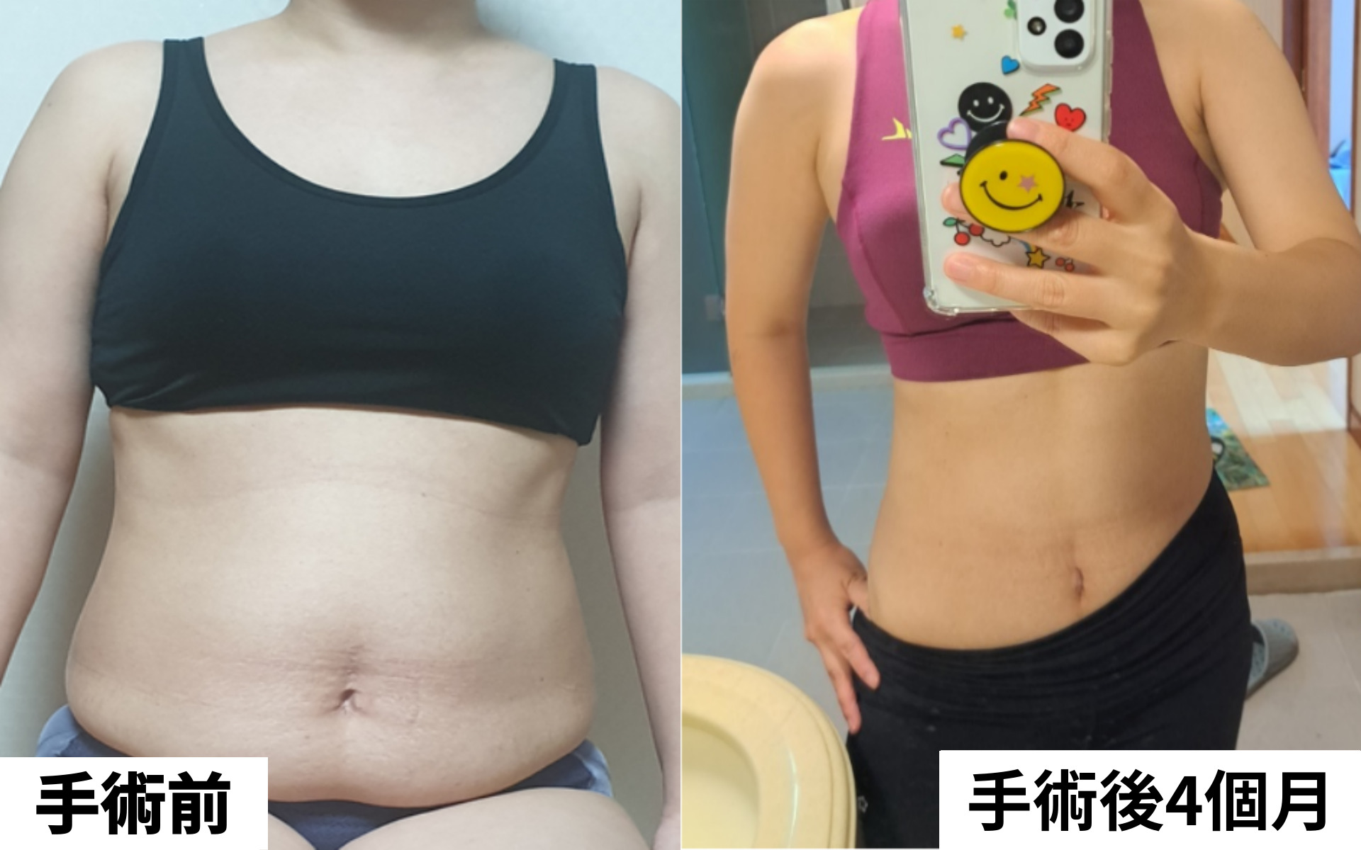 腹部整形術