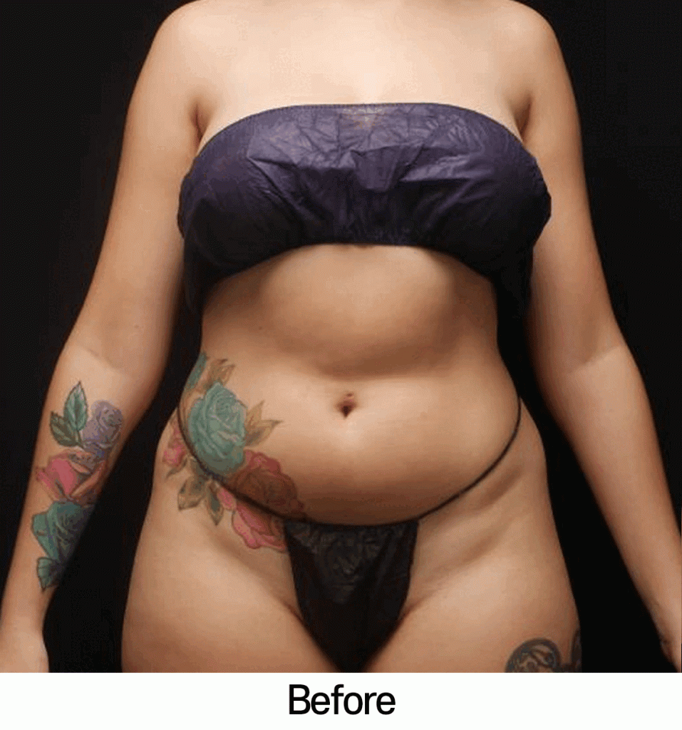 ab-etching-surgery
