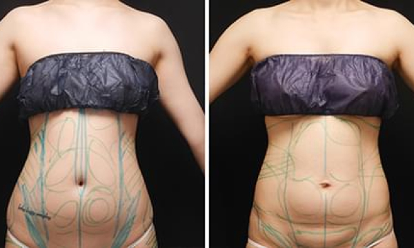 liposculpture-in-korea