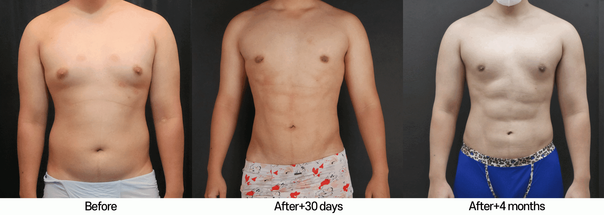Tummy Tuck After a C-Section: How to Ensure a Safe Procedure?