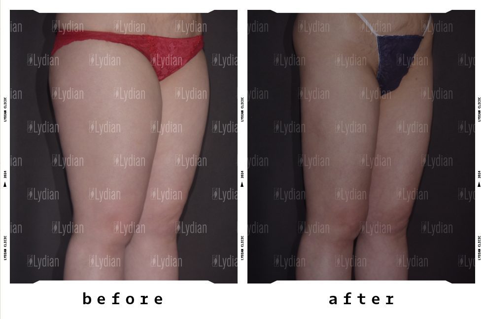 female thigh before and after liposuction