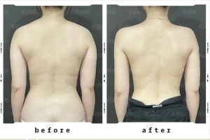 back liposuction