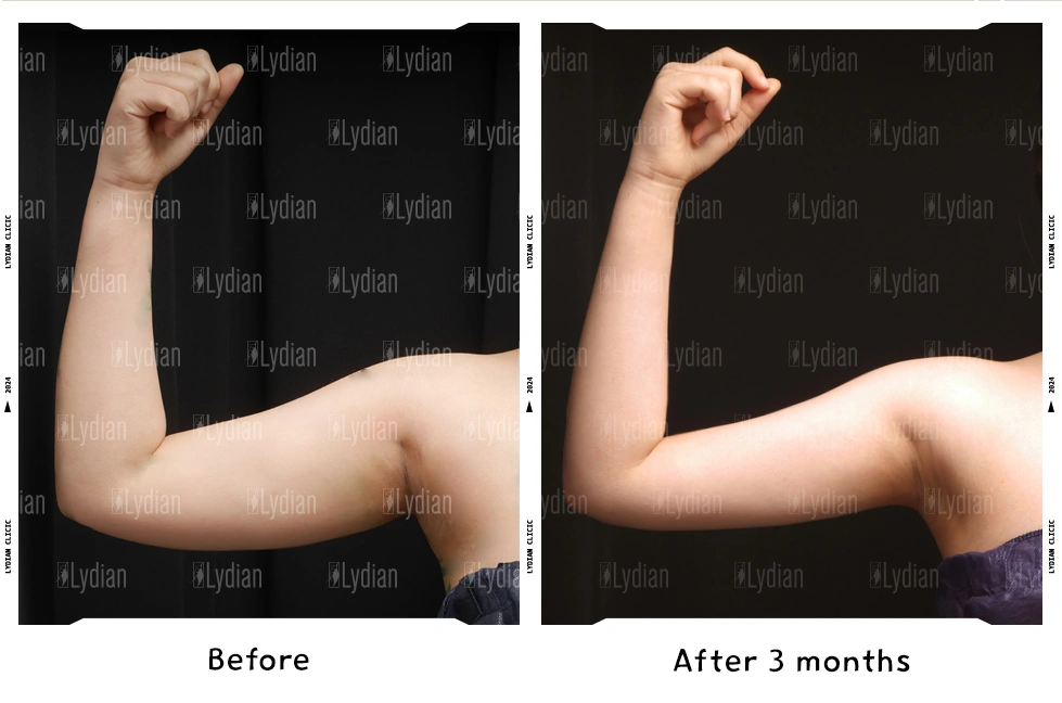 arm transformation before and after arm liposuction
