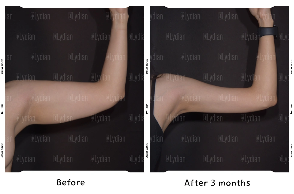 arm transformation before and after arm liposuction