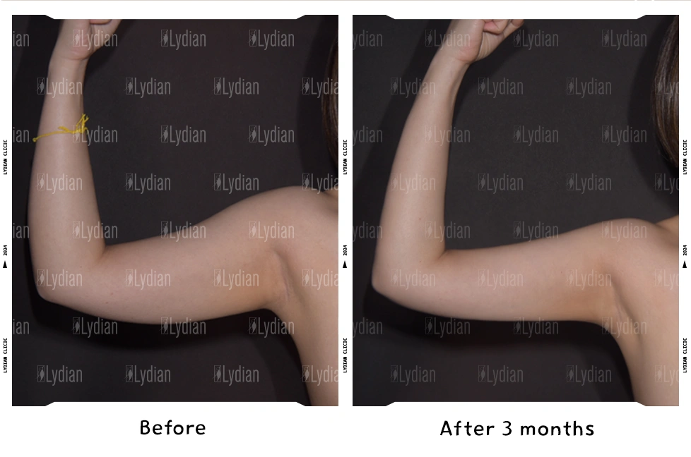female arm before and after liposuction