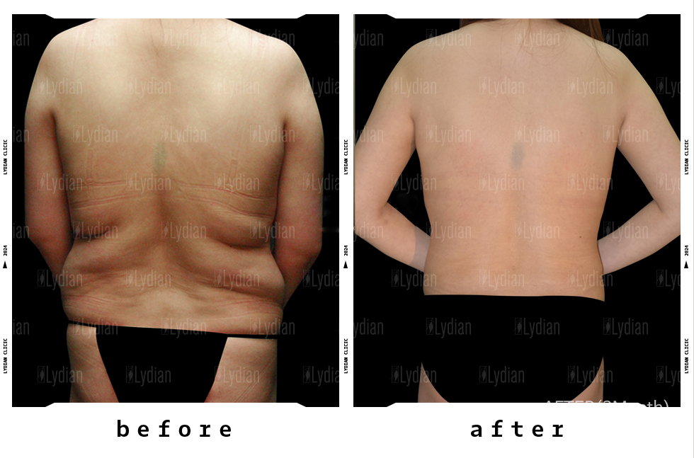 female backside after liposuction