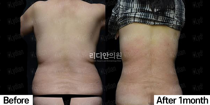 female back and waist liposuction results before and after