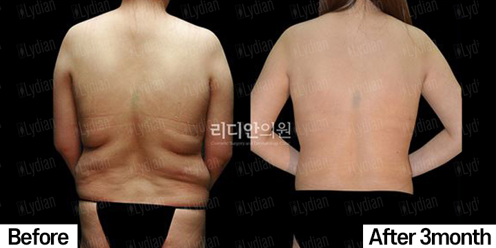 female love handle after liposuction