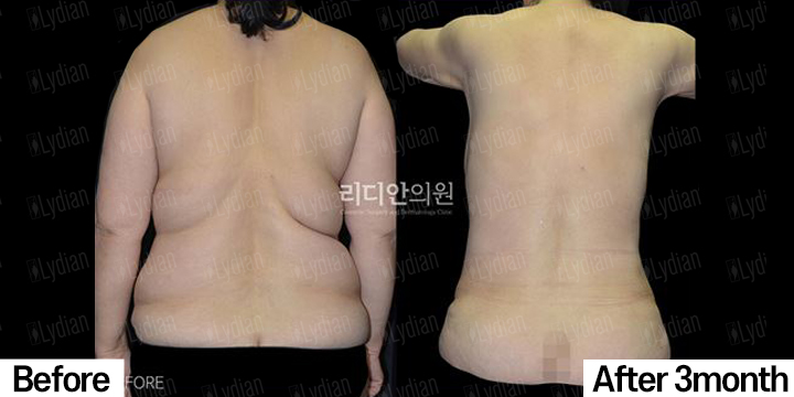 female back body before and after liposuction