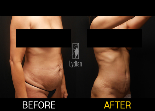 tummy before and after results following tummy tuck at lydian clinic