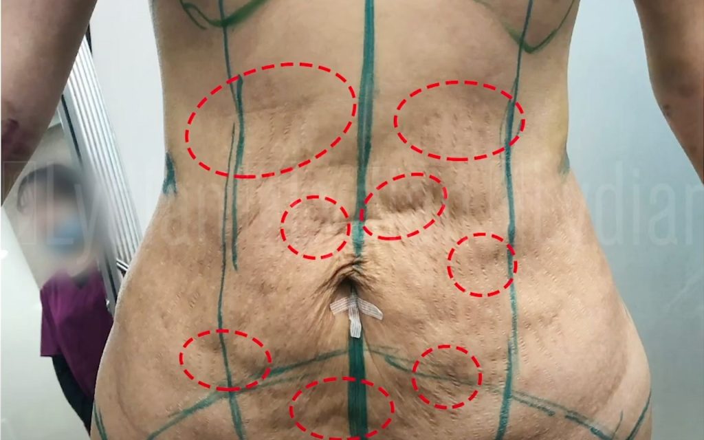 Revision Liposuction
