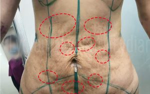 Revision Liposuction