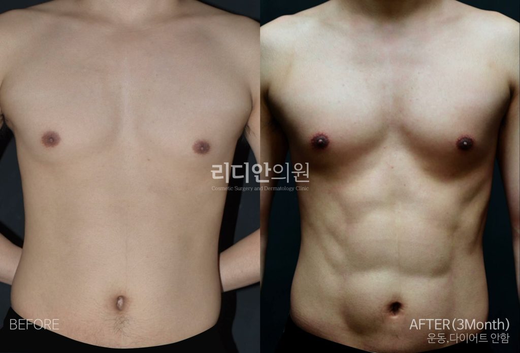 liposuction before and after transformation