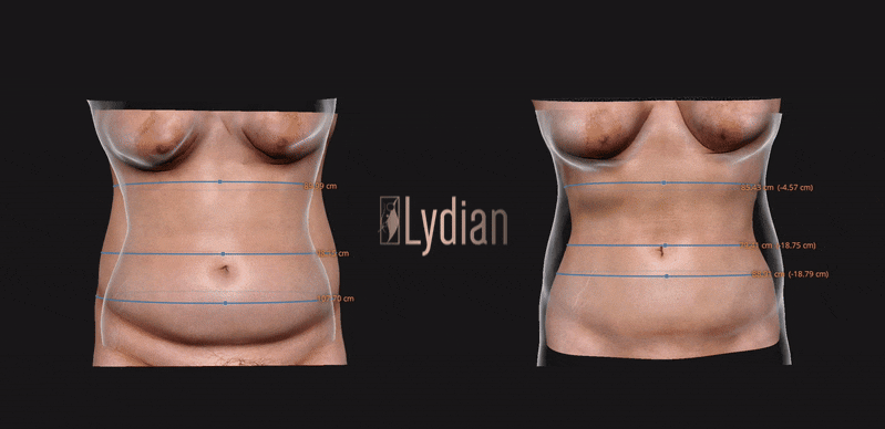 see before and after liposuction differences in 3d images