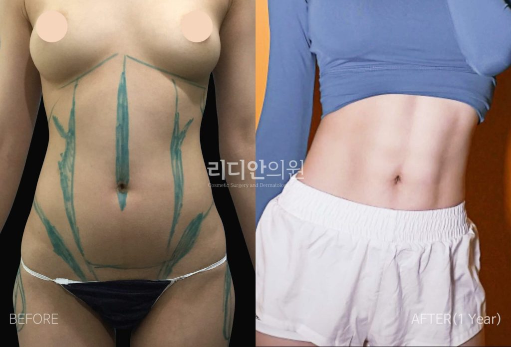 liposuction before and after belly structure