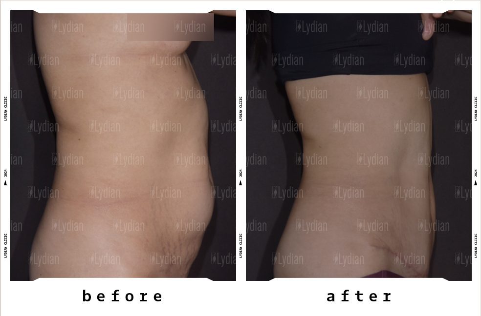 Before and after abdomen liposuction at Lydian Clinic Seoul