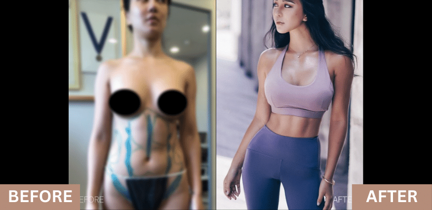 liposculpture body transformation before and after images