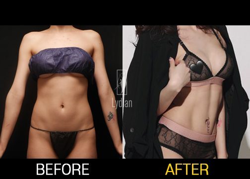 before and after woman liposuction changes