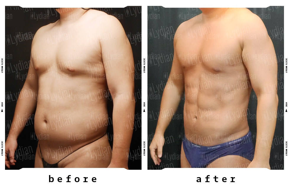 comparison of man body before and after liposuction