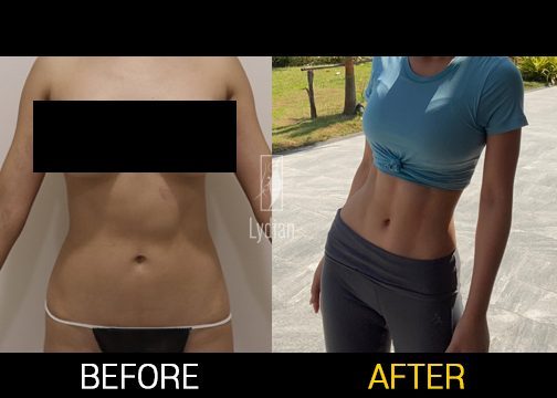 female tummy before and after liposuction