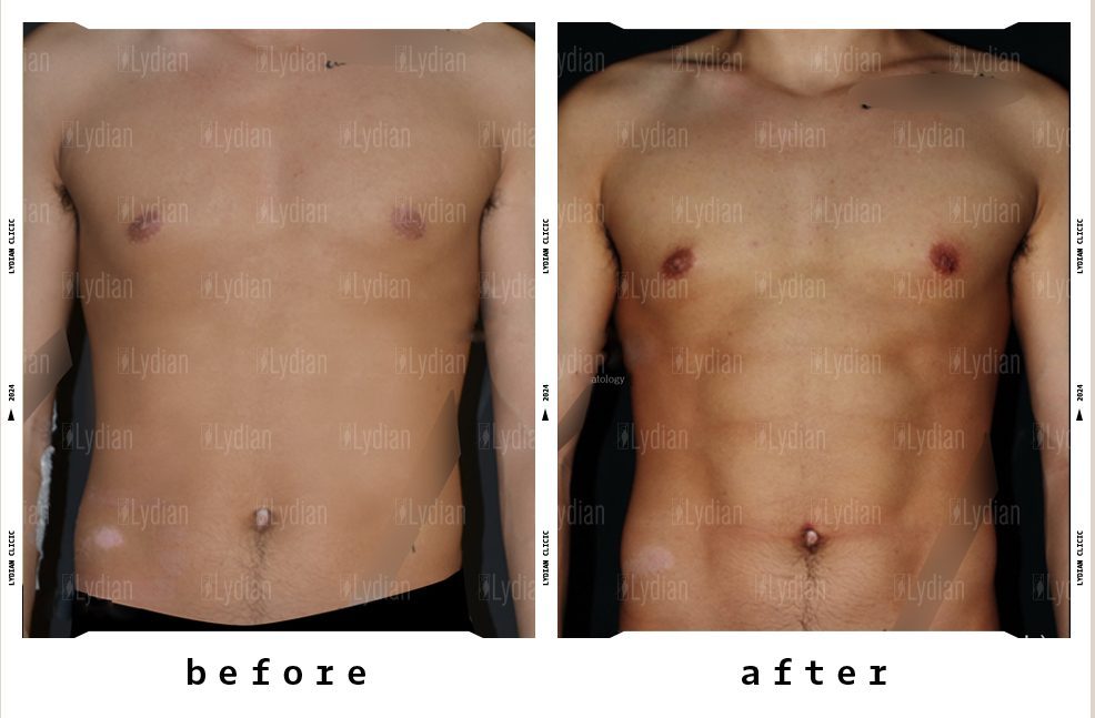 strong belly structure after liposuction