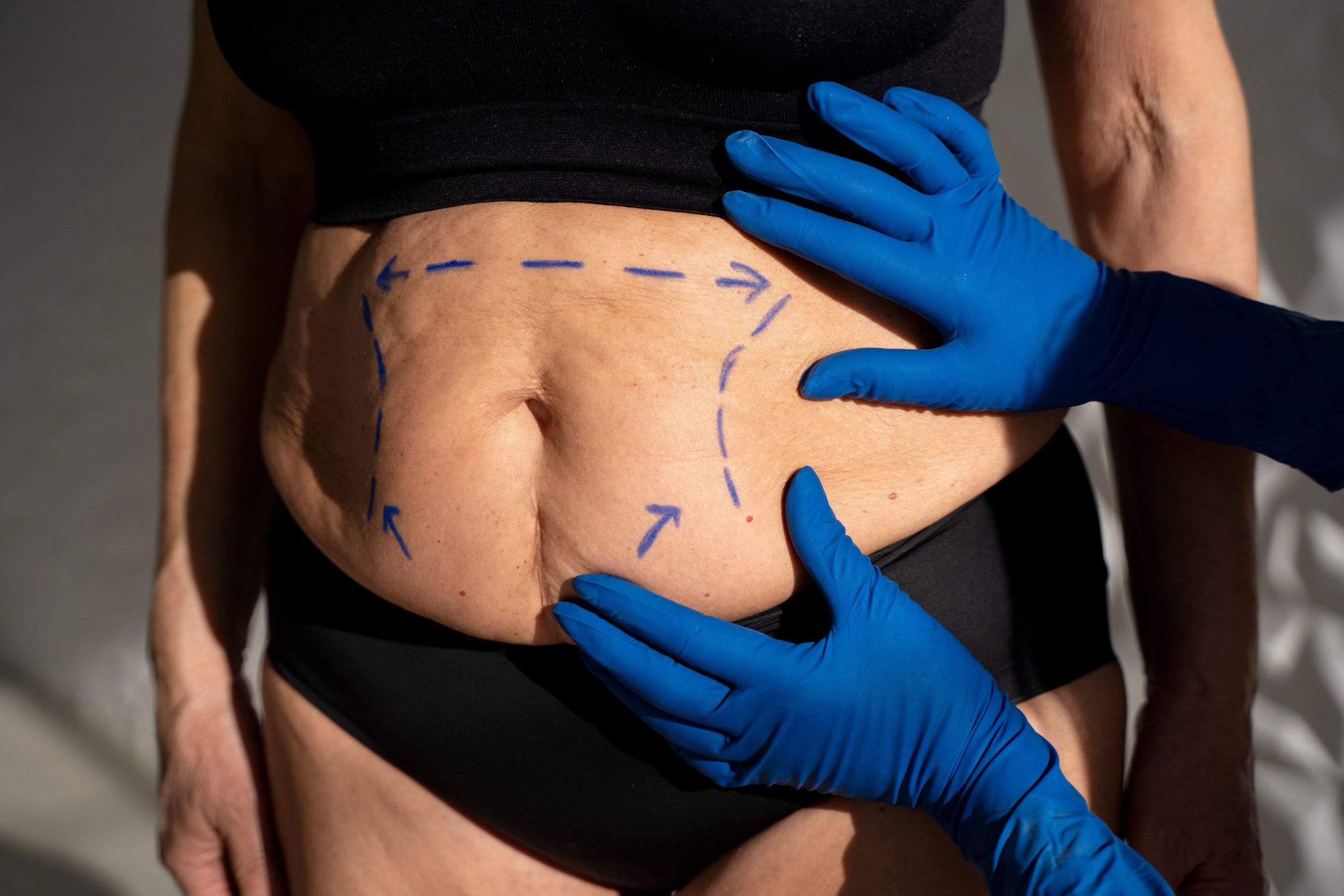 does-liposuction-hurt