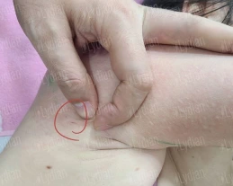 hand showing the mark in armpit of another person