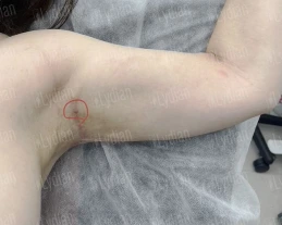 marking armpit with red circle