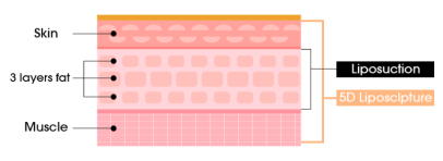 image showing liposuction for 3 layers fat and 5d liposculpture for skin and muscle