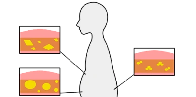 drawing showing fat in human stomach