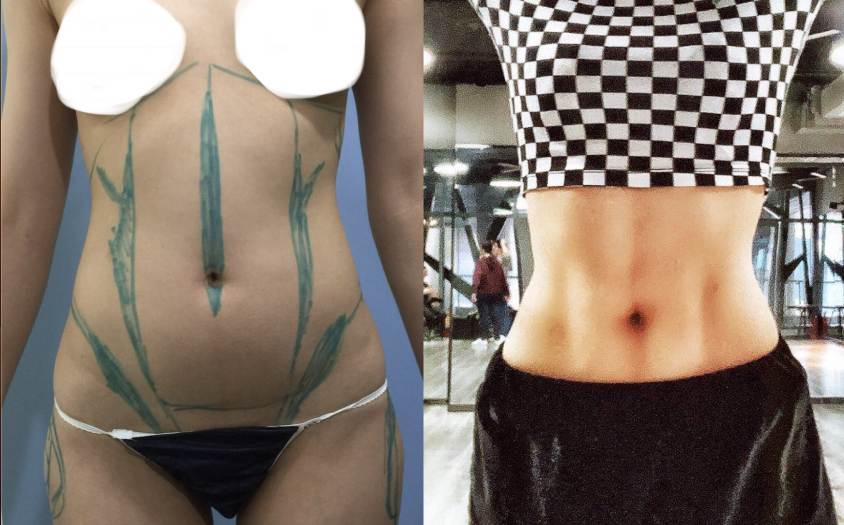 woman's stomach transformed to tight looking stomach