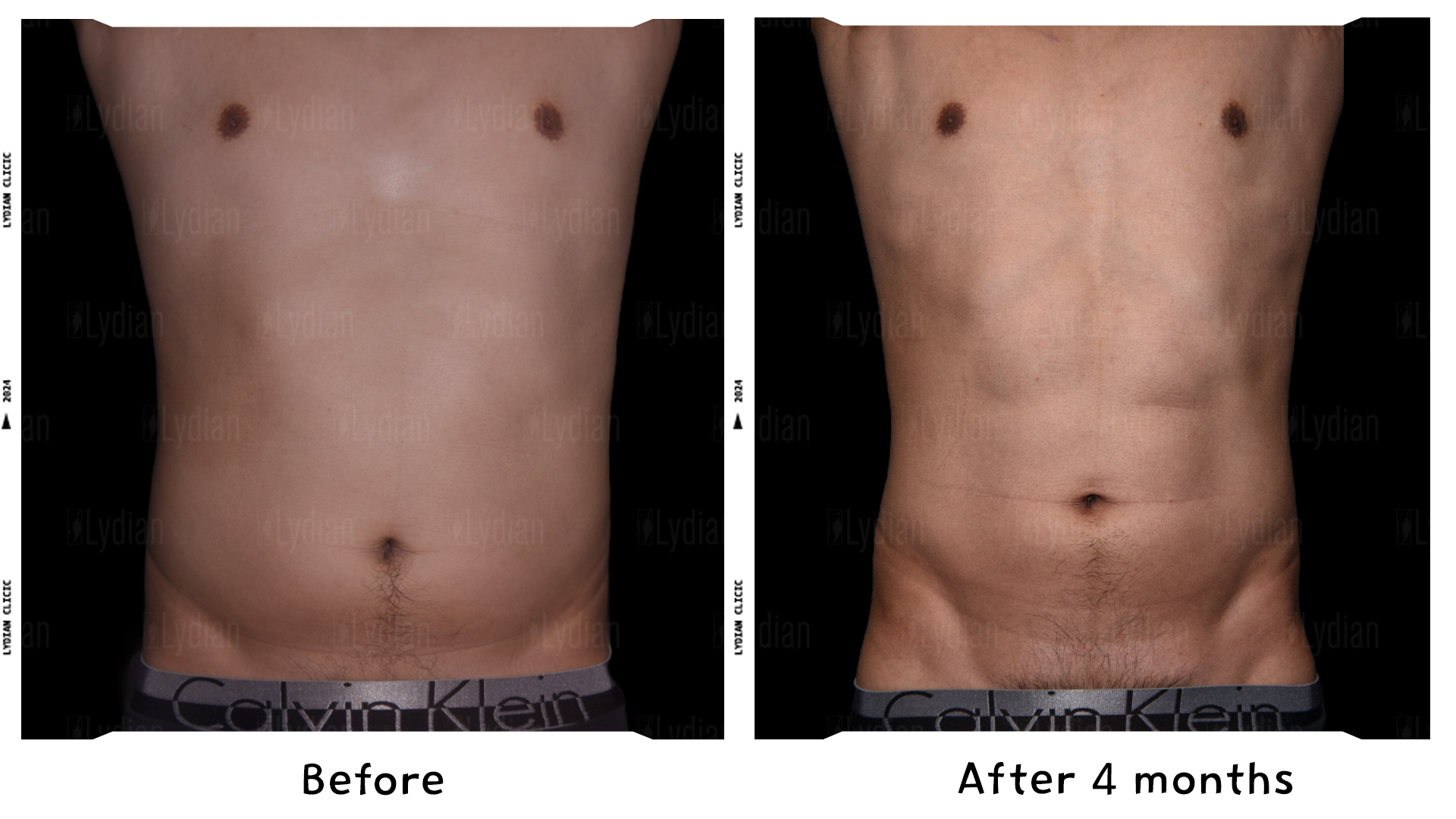 liposuction male abdomen before and after structure