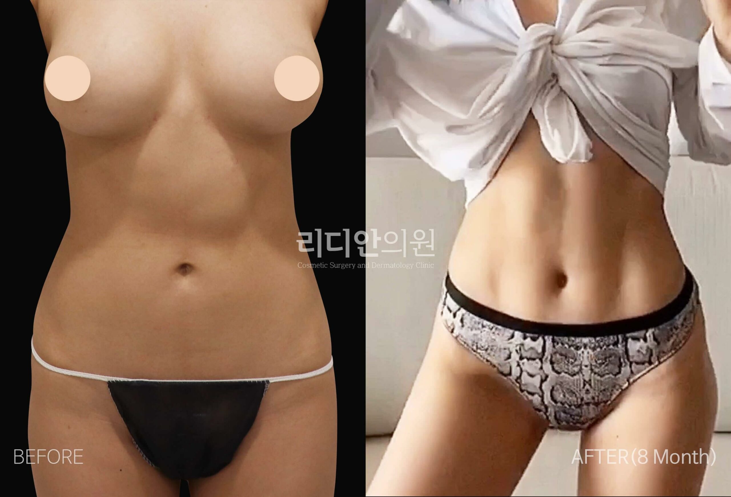 liposucion transformation of female belly before and after images