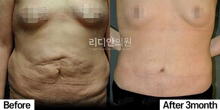 Abdomen liposuction results at 3 months, Lydian Clinic Seoul