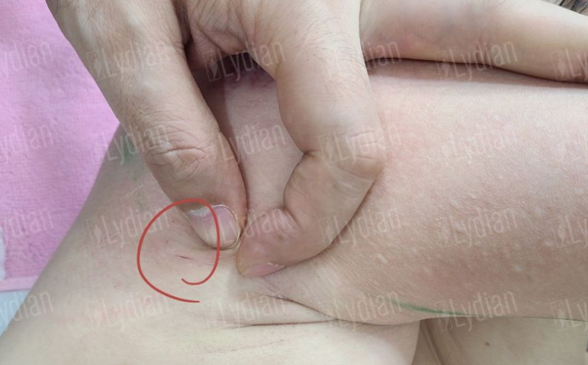 hand showing scar in legs