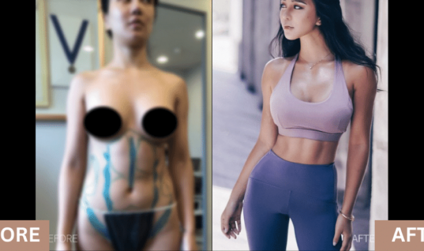 woman's body before and after cosmetic surgery
