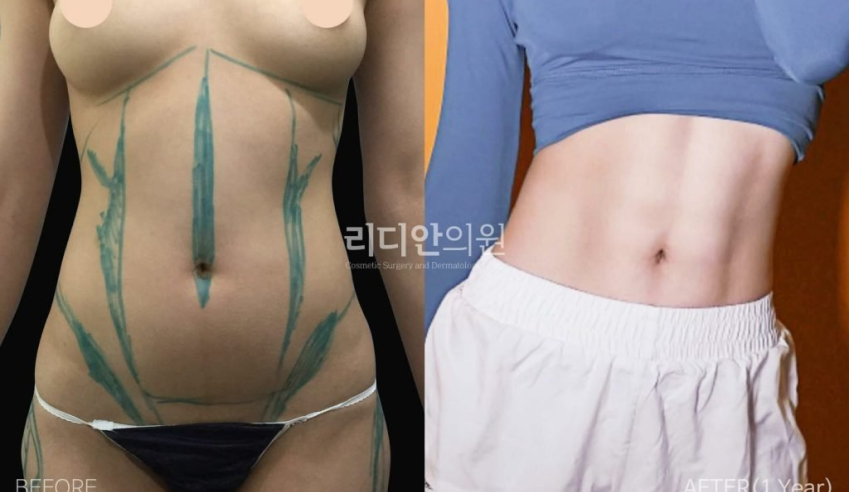 woman's belly transformed to slim and toned abdomen after surgery