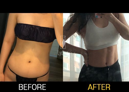 before and after result of female abdomen after liposculpture at lydian clinic