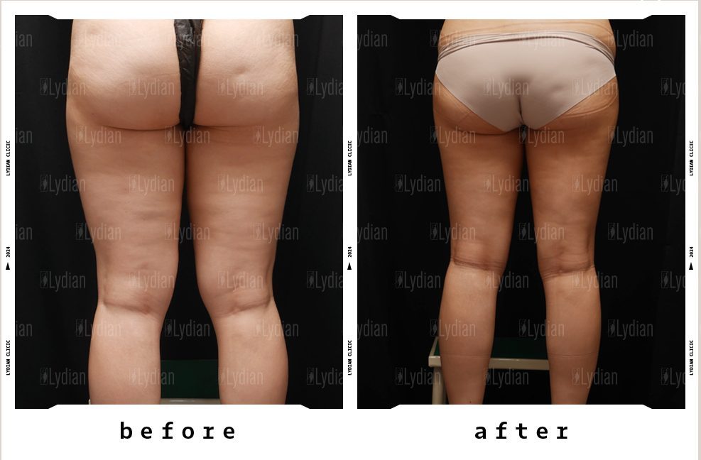 Before and after thigh liposuction at Lydian Clinic Seoul